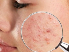 Tips Ingin Wajah Bebas Dari Jerawat dan Komedo